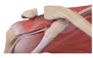 Physiotherapy acromioclavicular joint (ACJ) excision leaflet